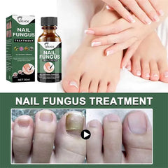 Anti-Funguses Nail Treatment