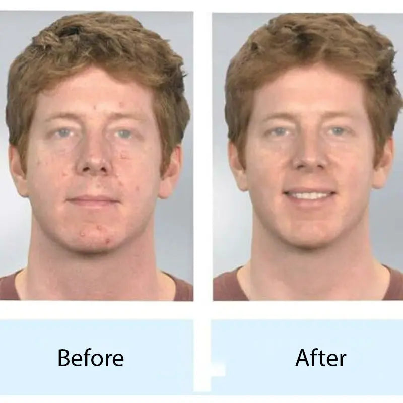 Blackhead Remover Instrument